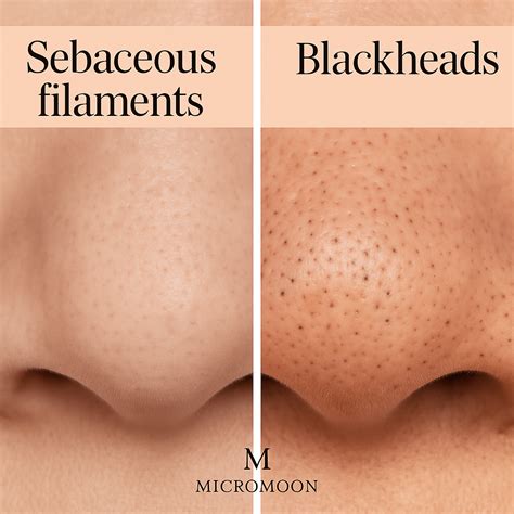 Sebaceous Filaments Nose
