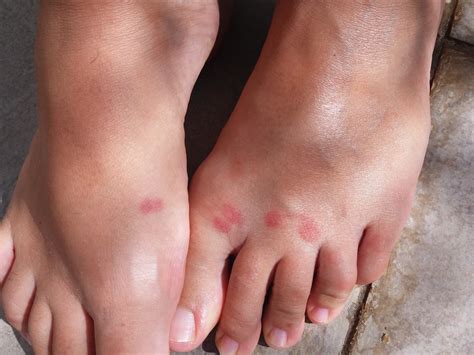 Mosquito Bites On Feet Won't Go Away at Maddison Pickworth blog