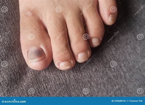 Close Up View of a Toe Nail with Purple Discoloration Due To an Injury. the Bruised Toe Nail is ...