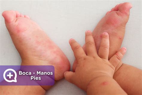 Enfermedad Boca Mano Pie En Ingles at Claire Melrose blog