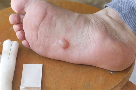 Foot Fungal Infection Blisters