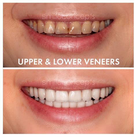 I Have Crooked Teeth: Should I Get Veneers or Invisalign?