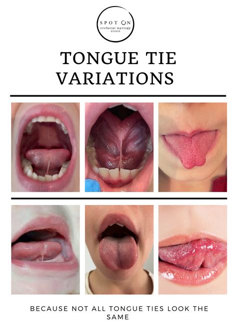 Tongue Tie — Spot On Orofacial Myology Clinic Darwin