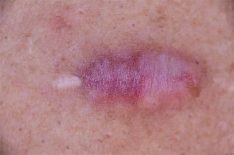 Lumpy Scars After Mohs Surgery | Dermatology and Skin Health - Dr. Mendese