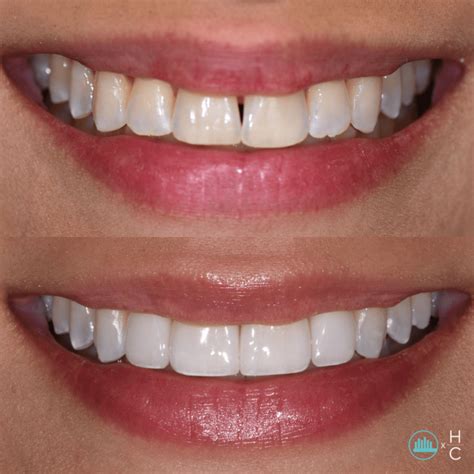 What Are Veneers | Definition, Define Process, Pros And Cons - CDS