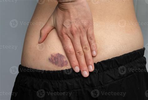 Woman having bruised on her butt. Bruises happen when small blood ...