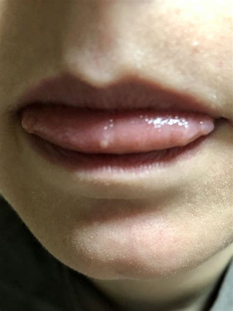 Lie Bumps On Tip Of Tongue