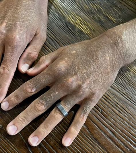Why Does Face Skin Turn Black at Larry Christensen blog