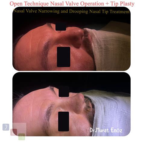 Nasal Valve Collapse and Treatment