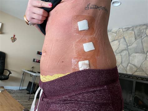 Sparkles and Lattes: Diastasis Recti and Umbilical Hernia Repair Surgery