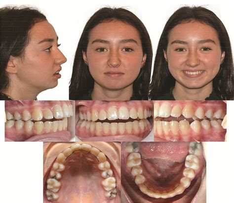 Progressive idiopathic condylar resorption: 6-year update - AJO-DO Clinical Companion