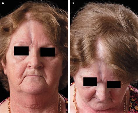 En Coup de Sabre | New England Journal of Medicine