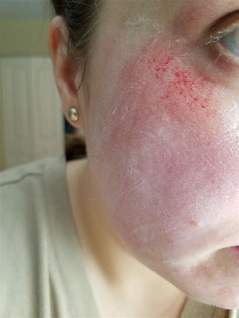 Products Burn My Face at Sandra Tillis blog