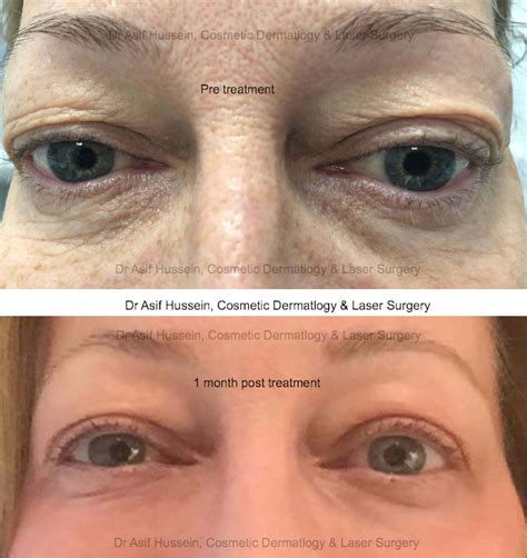 Laser Eyelid Lift