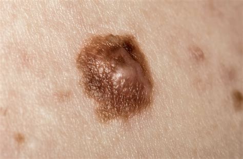 Pictures of cancerous moles: early stage, cancerous moles images, pictures of skin moles ...