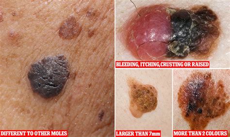 Cancerous Moles That Are Different How To Tell If A Mole Is Cancerous: