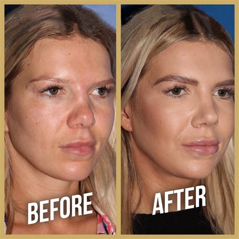What Is Deep Plan Facelift Surgery? - Health & Beauty Travel