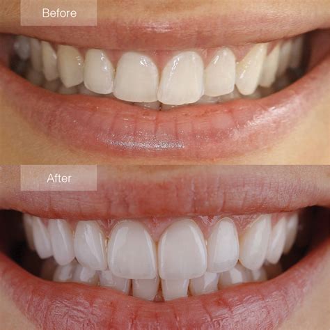 Porcelain Veneers in Newcastle NSW: Charlestown Dental Centre