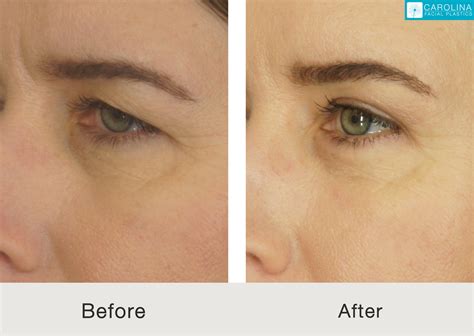 Plastic Surgery Endoscopic Brow Lift at Claire Ryder blog