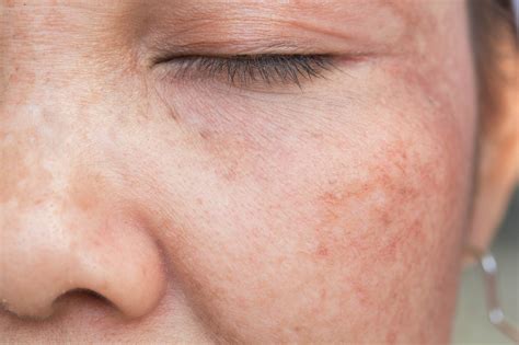 Brown Age Spots (Sunspots) - Glick Skin Institute