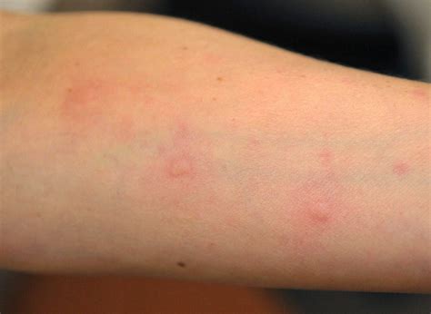 ¿Qué puede causar alergia en la piel?