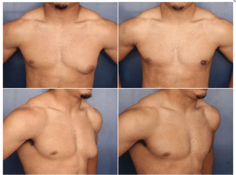 Does Gynecomastia Go Away