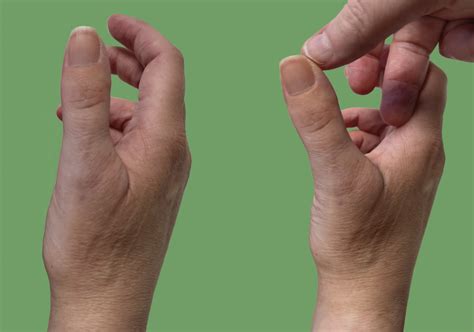 Collateral Ligament Finger