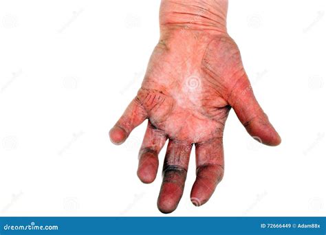 Artritis de la mano imagen de archivo. Imagen de calambre - 72666449