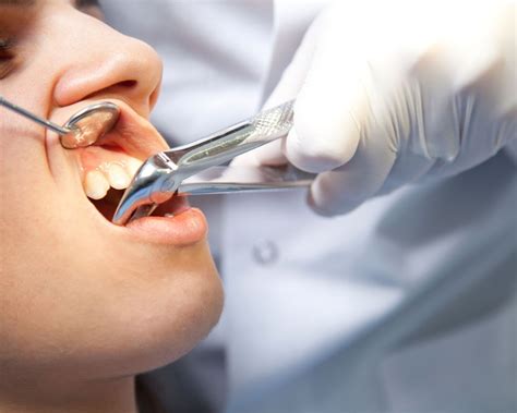 Tooth Extraction - Riverside Dental