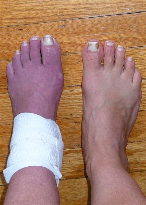 What Does It Mean When My Toes Are Purple at Koby Rawling blog