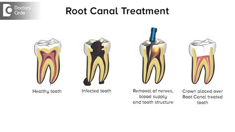 Root Canal And Crown