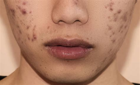 Acne Dark Spots On Face