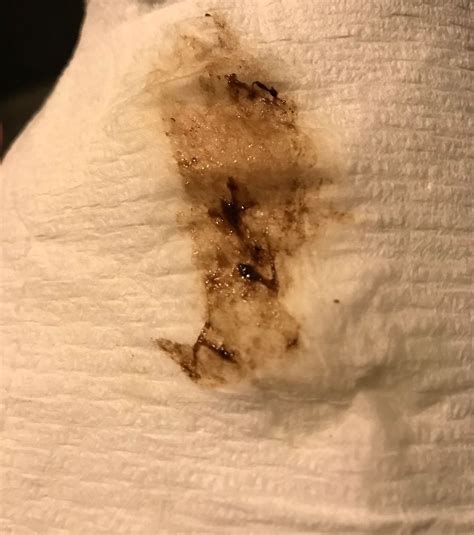 Implantation Bleeding Dark Brown