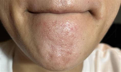 How do you get rid of these bumps on the chin? : r/Skincare_Addiction