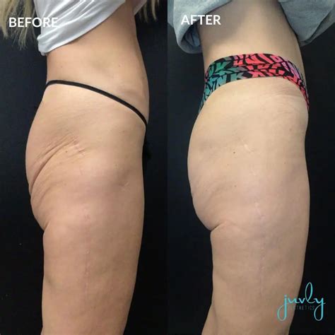 Juvly Aesthetics Gallery - Sculptra Butt Lifts - Juvly Aesthetics