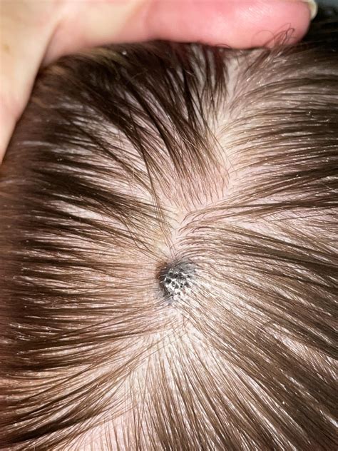 Moles On Scalp