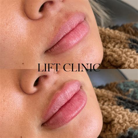 What Does 1ml of Lip Filler Look Like? 1ml Lip Fillers Before and After ...