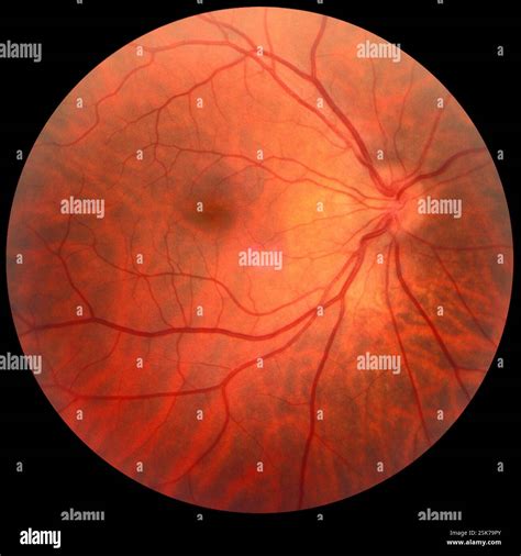 Optic disc drusen. Fundoscopy image of the retina of a patient's eye in a case of optic disc ...