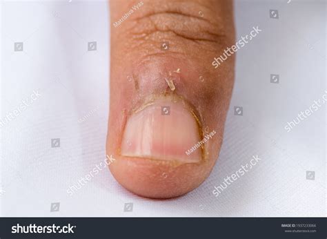 Hangnail Condition Caused Due Excessive Dryness Stock Photo 1937233066 | Shutterstock