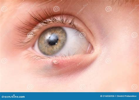 Children S Right Eye and Swollen Barley on the Lower Eyelid. Macro, Close-up Stock Photo - Image ...