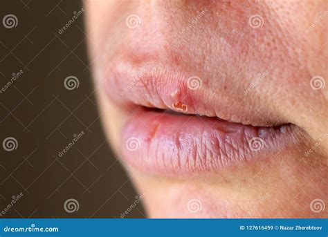 Can Herpes Live On Lip Balm at Qiana Flowers blog