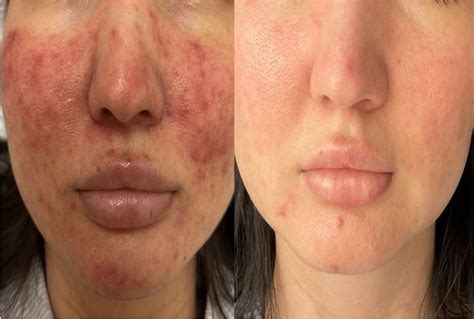 Photos : Couperose / Rosacée sur le visage et le nez | Skin Marceau