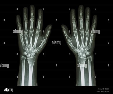 X Ray Normal Hand