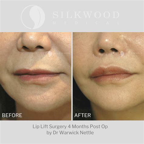 Lip Lift Sydney | Before and After Gallery | Dr Warwick Nettle | Lip surgery, Lips inspiration, Lips