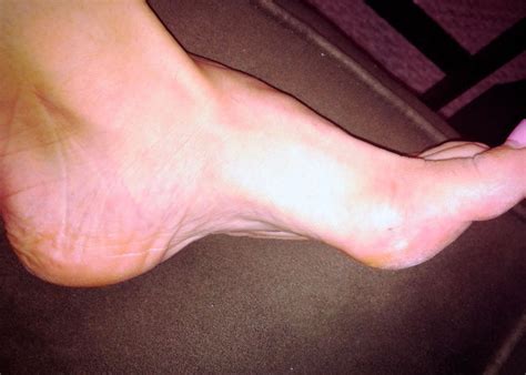 Dolor en el Empeine del Pie: 7 Causas y Tratamiento - eFISIO ...