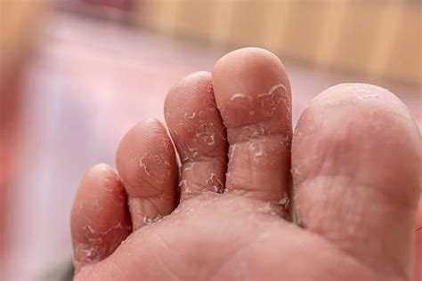 Athlete’s foot (Tinea pedis): Prevention and Treatment | The Foot Hub