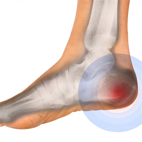 pain in heel of foot after running