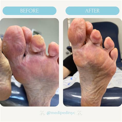 Medi Pedi NYC | Safe & Painless Foot Care | At Medi Pedi NYC, we take ...