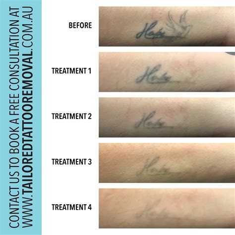 Treatment Progress — Tailored Tattoo Removal Melbourne