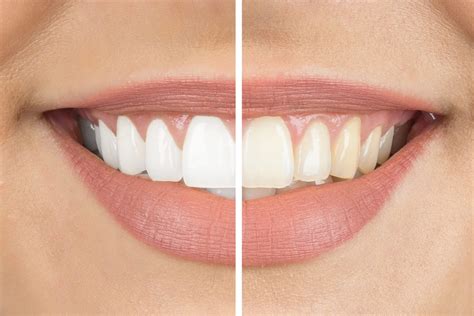 4 Cosmetic Dentistry Procedure to Improve Your Smile - Arizona Periodontal Group